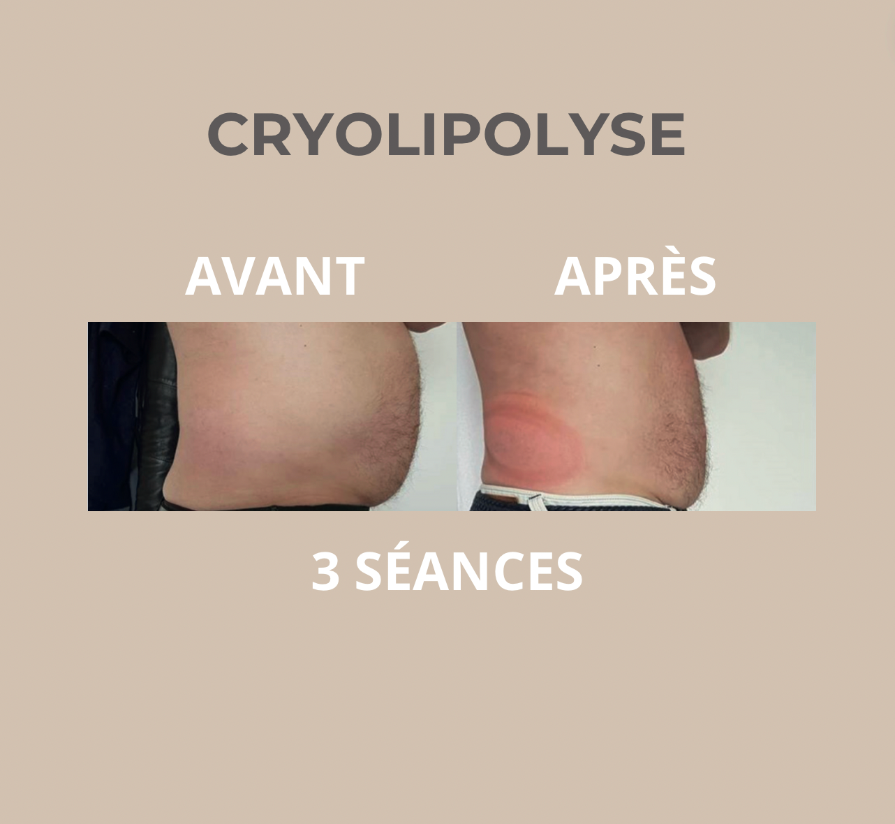 Cryolipolyse Périgueux — second résultat avant / après sur 3 séances