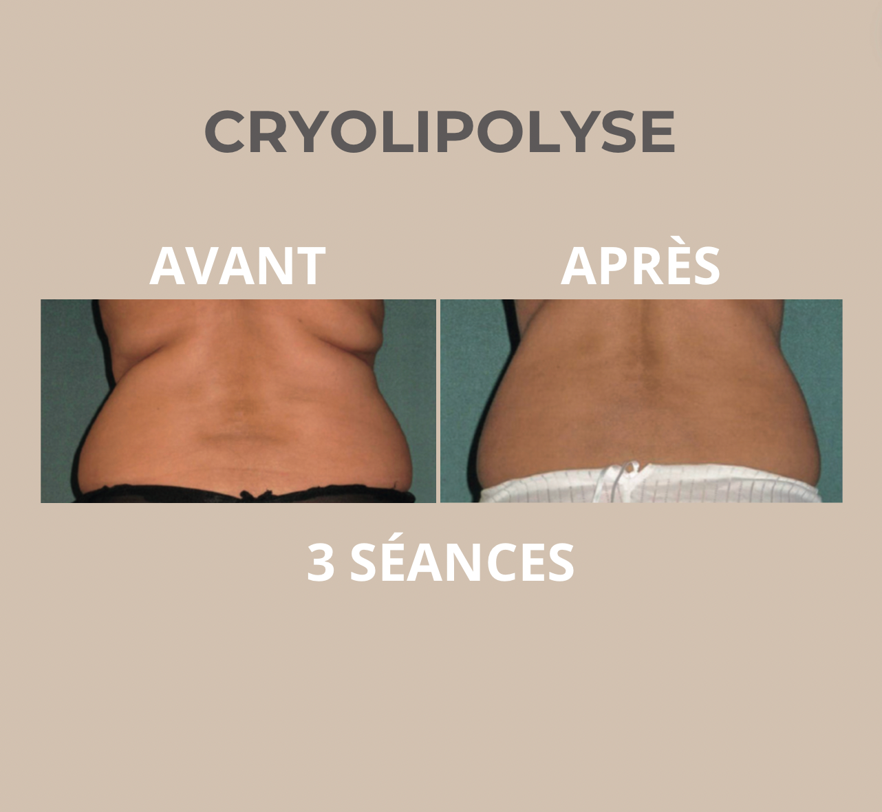 Cryolipolyse Périgueux — résultat avant / après sur 3 séances